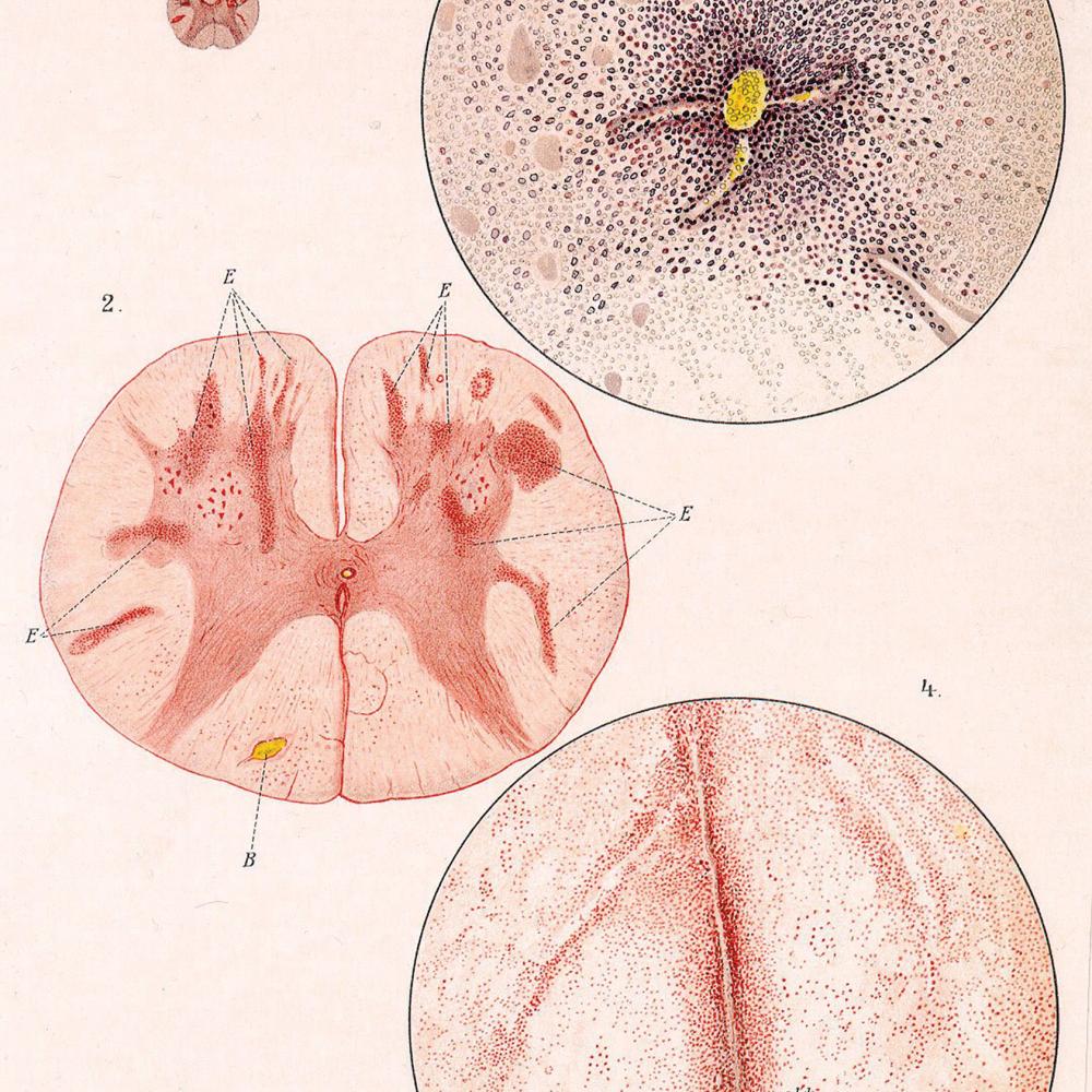 Diagrams showing pox infections in cross sections of the brain and in the cells of the spine