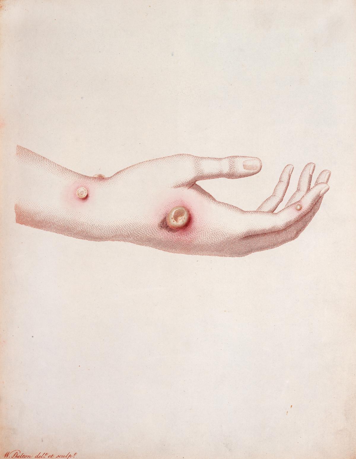 Illustration of red pustules on an outstretched hand