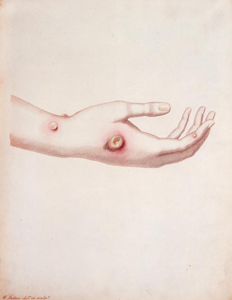 Illustration of red pustules on an outstretched hand