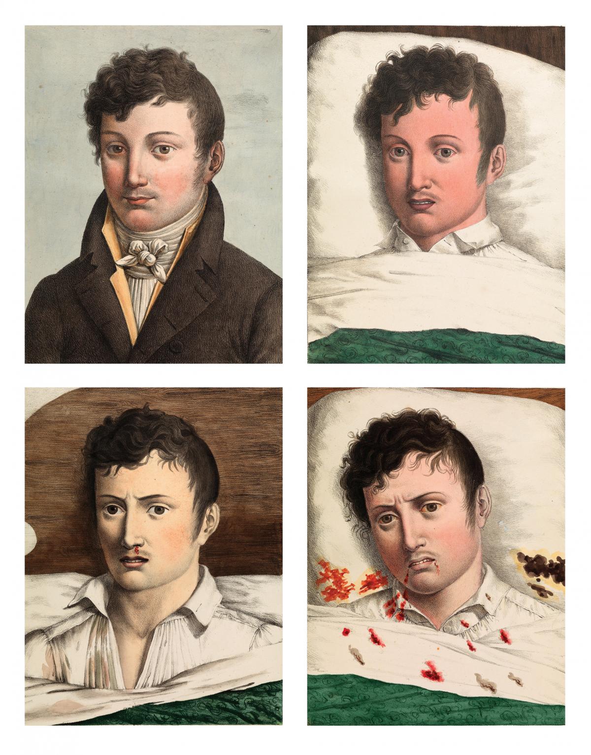 four stages of yellow fever