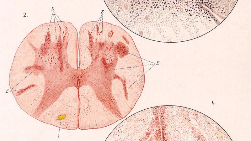 Diagrams showing pox infections in cross sections of the brain and in the cells of the spine